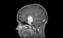 Nel cervello aveva un "palloncino" di quattro centimetri pronto a esplodere: 24enne rischia la vita per un aneurisma gigante