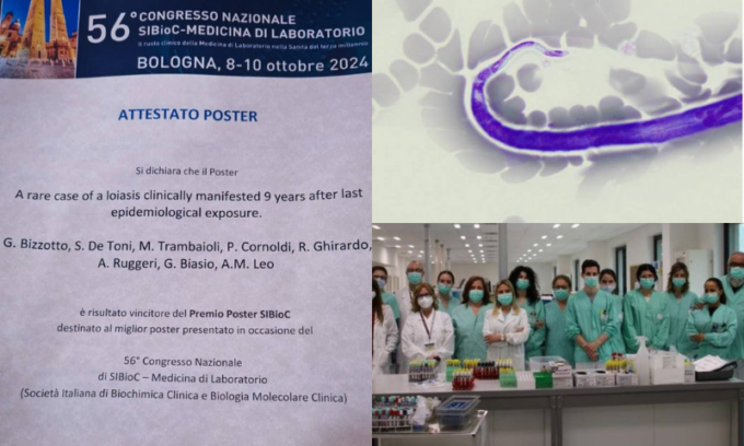 “Ho qualcosa che si muove nell’occhio”, rara malattia causata dal verme Loa Loa curata nel Padovano