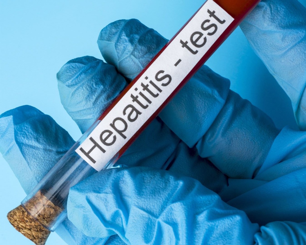 Caso di Epatite A registrato a Padova: è un turista rientrato da Napoli
